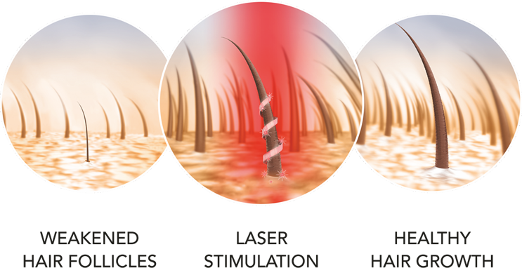 introduces Pro12 Laser Device